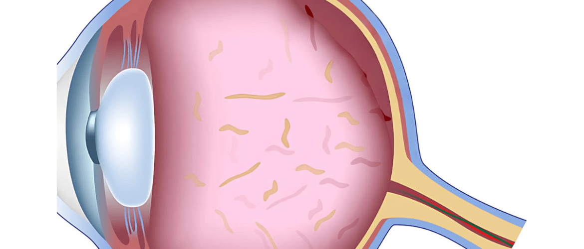 Eye Floaters Diagram