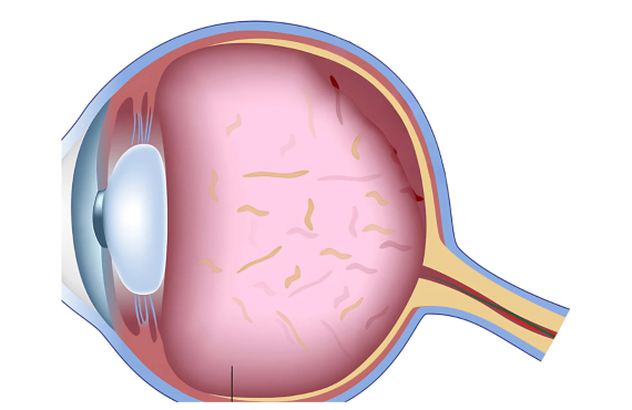 Eye Floaters Diagram