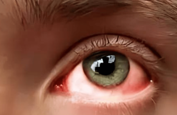 eyes that have got stroke