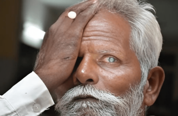 Exploring the 3 Types of Cataract Surgery-min